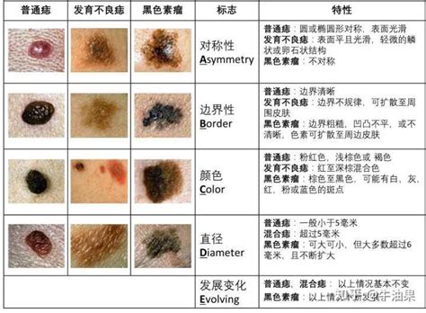 手臂長痣|痣是什麼？會變成黑色素瘤？7種一定要除的痣